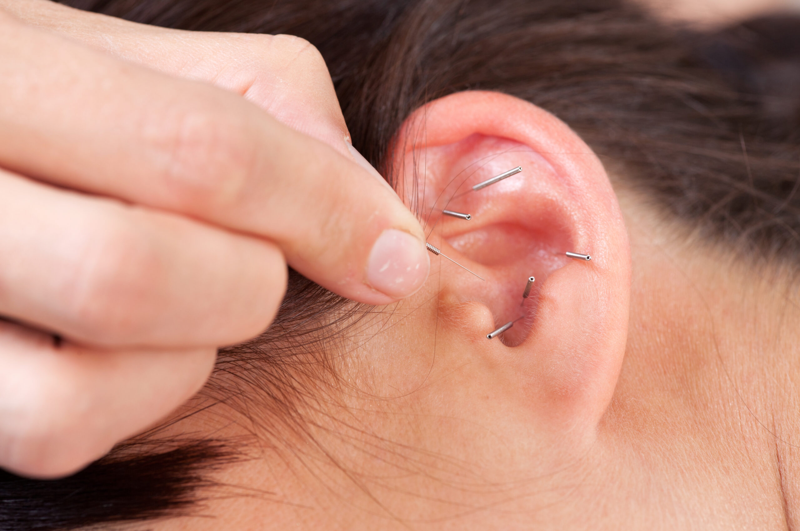 Ear Acupuncture Detail